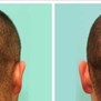 Affordable Hair Transplants New York in Rye Brook, NY