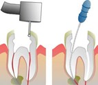 Root_Canal_retreatment_in_Davis_CA.jpg