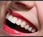 Teeth_Whitening_Milpitas_CA.jpg