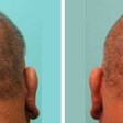 Robotic Hair Transplants Melbourne in West Palm Beach, FL