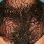 Affordable Hair Transplants Charlotte in Charlotte, NC