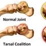 Tarsal Coalition Surgery in New York, NY