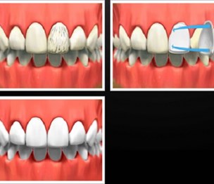 Fresno Smile Makeovers