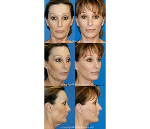 Carmel Valley Facial Plastic Surgery