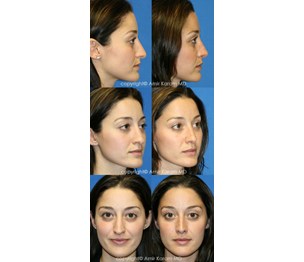 Carmel Valley Facial Plastic Surgery