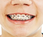 Braces_Bryan_TX.jpg