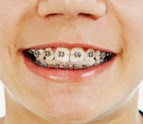 Braces_Tomball_TX.jpg