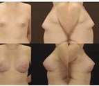 BreastAugmentation.jpg