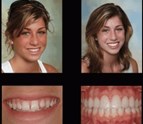 Dental_Implants_brewster_ny.jpg