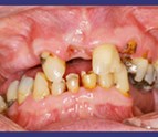 Dental_implants_in_Bronx_NY.jpg