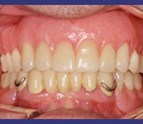 Dentures_in_Bronx_NY.jpg