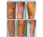 Endovenous_Laser_Treatment_for_Varicose_Veins.jpg