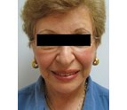 Face_Lift_in_Coral_Gables_FL.jpg