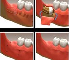 Fresno_Dental_Implants.jpg