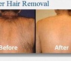 Laser_Hair_Removal_Pewaukee_WI.jpg