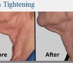 Skin_Tightening_Pewaukee_53072.jpg