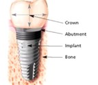 dental_implants_Best_Endodontics_of_Glenview_Ltd.jpg