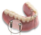 dental_implants_Seminole_FL.jpg