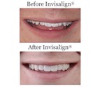 invisalign_in_Colorado_Springs_CO.jpg